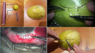 Faisal's Apple trabeculectomy training video