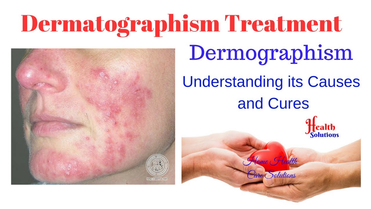 Dermatographism Treatment Dermographism Understanding Its Causes