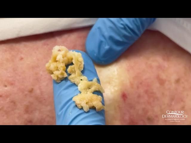 Removing a Ruptured Epidermoid Cyst