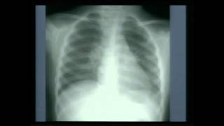 TB (Part2) Tuberculosis Primary Part 2