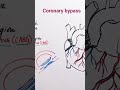 Coronary Bypass #bioexplorawithnarain #biology #education #lifeforms #fypシ #bloodpressure