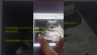 Usg Abdomen - Double Barrel Sign Cholelithiasis