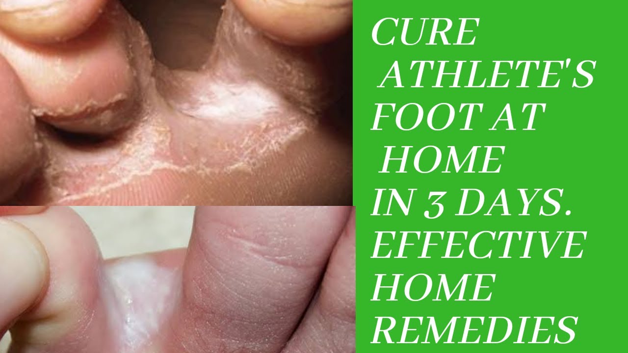 HOW TO PREVENT & CURE ATHLETE'S FOOT OR FOOT FUNGUS & TOE NAIL FUNGUS