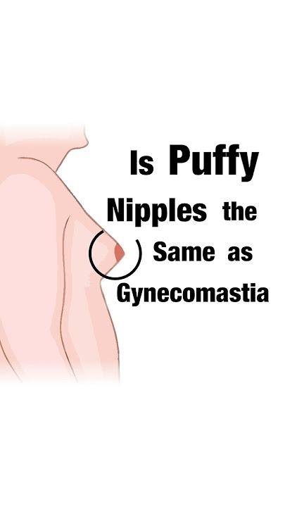 Are Puffy Nipples The Same As Gynecomastia? Dr. Aniketh Venkataram, The Venkat Center, Bengaluru