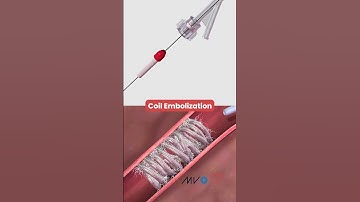 What Is Coil Embolization? | Animated Medical Explanation