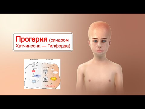 Прогерия (синдром Хатчинсона — Гилфорда)