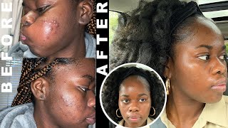 HORMONAL ACNE UPDATE : 6 MONTHS ON SPIRONOLACTONE & ARAZLO by OLUSHOLA MOGAJI 10,018 views 3 years ago 8 minutes, 7 seconds