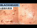 8連殺的黑頭粉刺(blackheads) - Taiwan Tainan台南清粉刺最乾淨