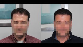 Don't Lose Hope! It is Possible to Fix a Bad Hair Transplant