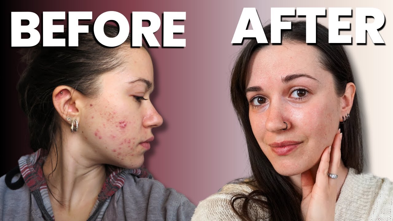 How to Get Rid of Acne Naturally | How I Healed My Cystic Acne Without ...