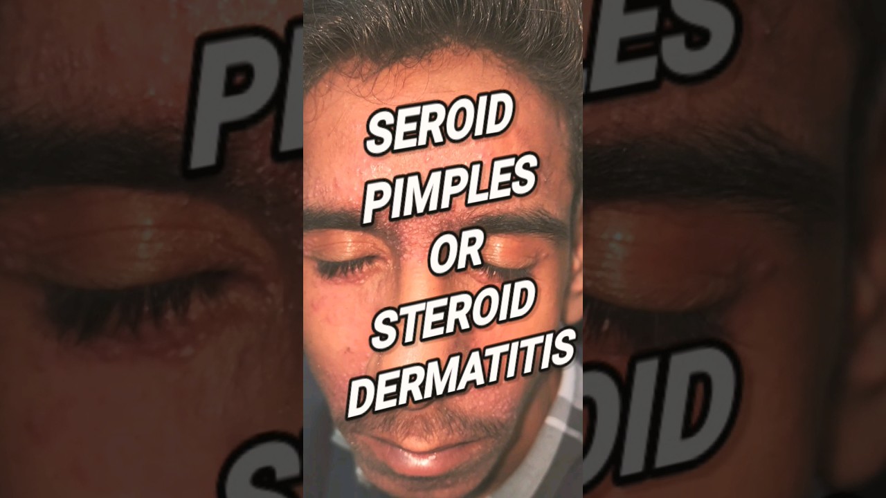 Steroid cream side effects on face DrArifMDDermatologist steroidacne