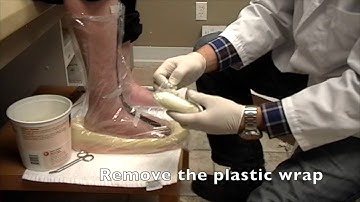 Casting and measuring for Custom Footwear for Charco feet.