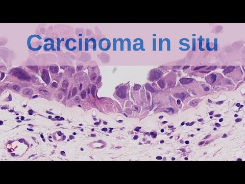 Video: Dijagnoza I Upravljanje Preinvazivnom Bolešću Dojke: Duktalni Karcinom In Situ (DCIS) I Atipična Duktalna Hiperplazija (ADH) - Trenutne Definicije I Klasifikacija