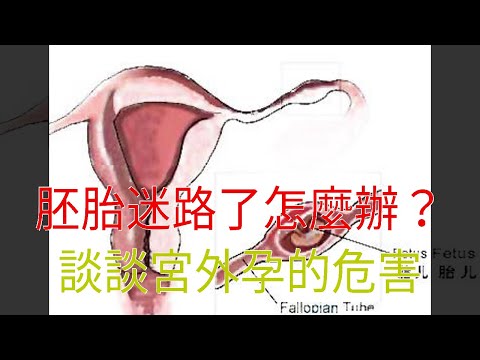 胚胎迷路了怎麼辦？談談宮外孕的危害