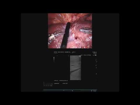 Robotic left hepatectomy and limphadenectomy for cholangiocarcinoma