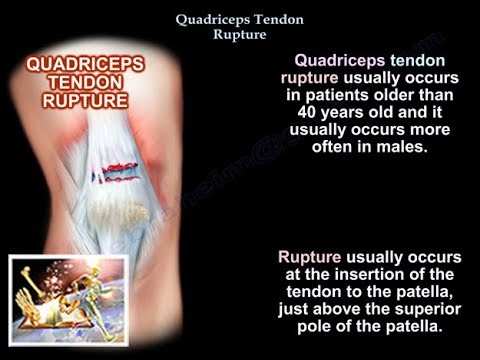 Video: Quadriceps Tendonitis (Tendinopathy) Penyebab Dan Perawatan