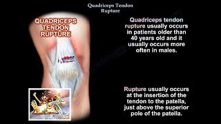 Quadriceps Tendon Rupture - Everything You Need To Know - Dr. Nabil Ebraheim