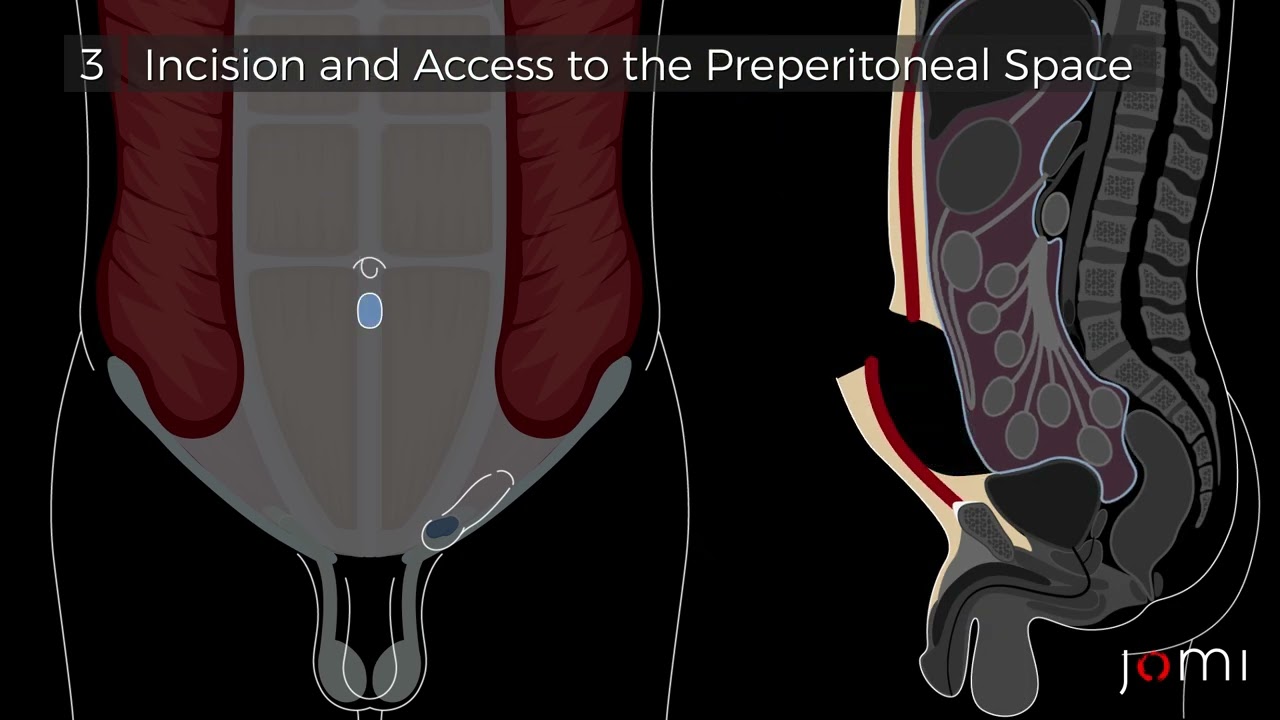 Laparoscopic Totally Extraperitoneal (TEP) Left Indirect Inguinal Hernia Repair with Mesh