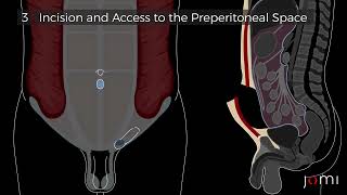 Laparoscopic Totally Extritoneal Tep Left Indirect Inguinal Hernia Repair With Mesh