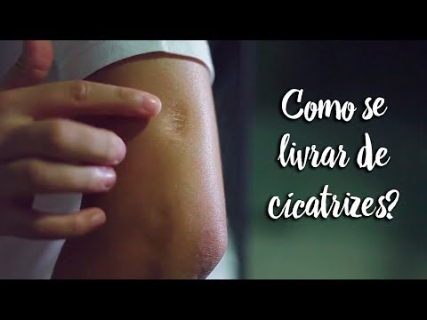 Vídeo: Como Se Livrar De Cicatrizes