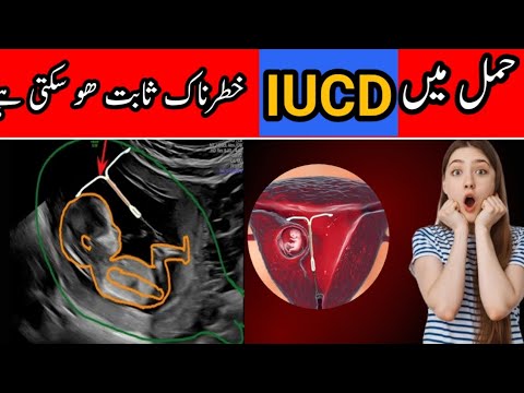 best time for iud (family planning method) - YouTube