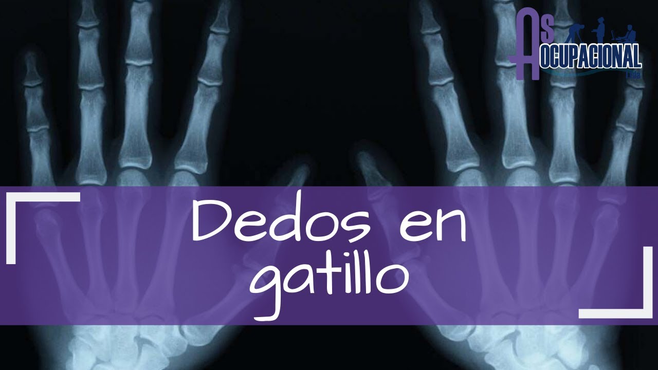 DEDOS EN GATILLO CAUSAS DEDOS EN GATILLO TRATAMIENTO YouTube