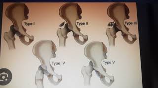 Revise Thompson And Ebstein Clification Of Posterior Hip Dislocation Orthopedics