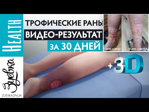 Трофические язвы (3D анимация) Причины и способы восстановления. НАШ ВИДЕО РЕЗУЛЬТАТ за 30 дней!!!