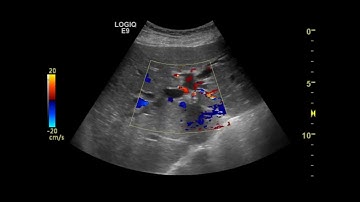 Mirizzi syndrome - Csendes classification type III (by endoscopic retrograde cholangiography)