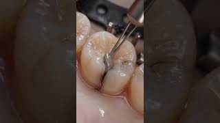 Broken Surface Decay – Crack leading to cavity formation #dentaltransformation