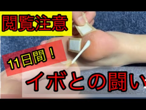 【閲覧注意】足裏にできたイボとの闘い‼️木酢液使用　Fight viral warts!uses wood vinegar.