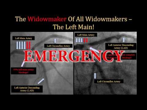 Video: Widowmaker Heart Attack: Definisi, Gejala, Kelangsungan Hidup Dan Banyak Lagi