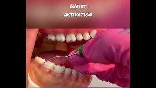 Demonstration of the 11/12 Explorer on posterior teeth. Teeth numbers 31-29.