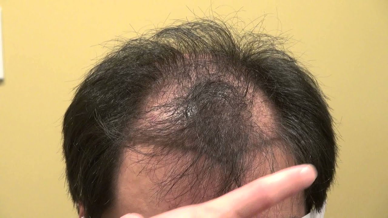 Frontal Bald Hair Loss Restoration Surgery Los Gatos Near San Jose CA