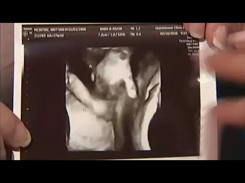 Woman Lived with a 'Twin' Inside Her for 17 Years Without Knowing