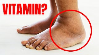 #1 Vitamin to Eliminate Swelling in Feet and Legs