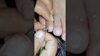 toenail Cleaning #satisfying #nailcare #primerfordryskin