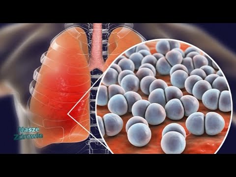Wideo: Objawy Infekcji Płuc: Diagnostyka, Leczenie I Nie Tylko