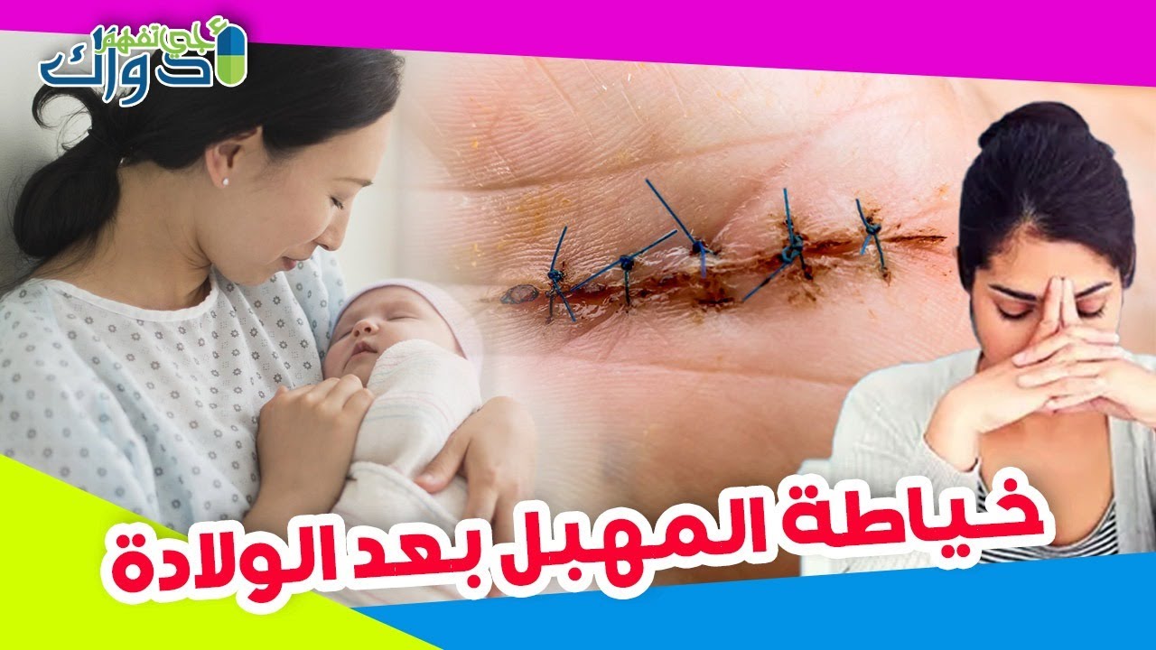 مباشرة الخياطة التجميلية بعد الولادة الخياطة التجميلية