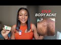 How to Get Rid of Body Acne (What Actually Worked for Me)