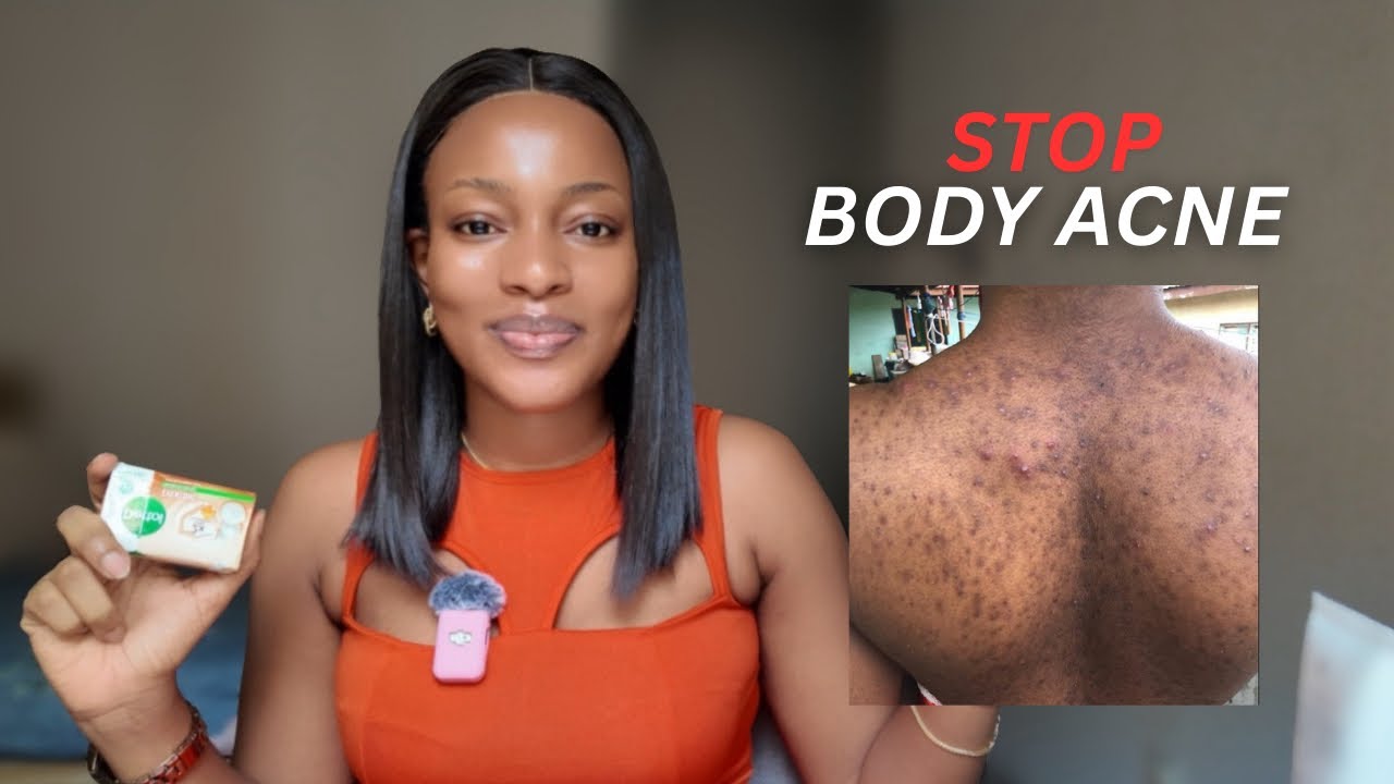 Как избавиться от прыщей на теле (что действительно помогло мне)