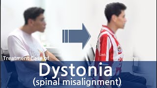 Dystonia / Cervical Dystonia / Spasmodic Torticollis / 사경증 치료사례 / 근긴장이상증 @YJCareClinic