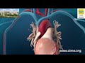 Coronary artery angioplasty radial access  cims hospital