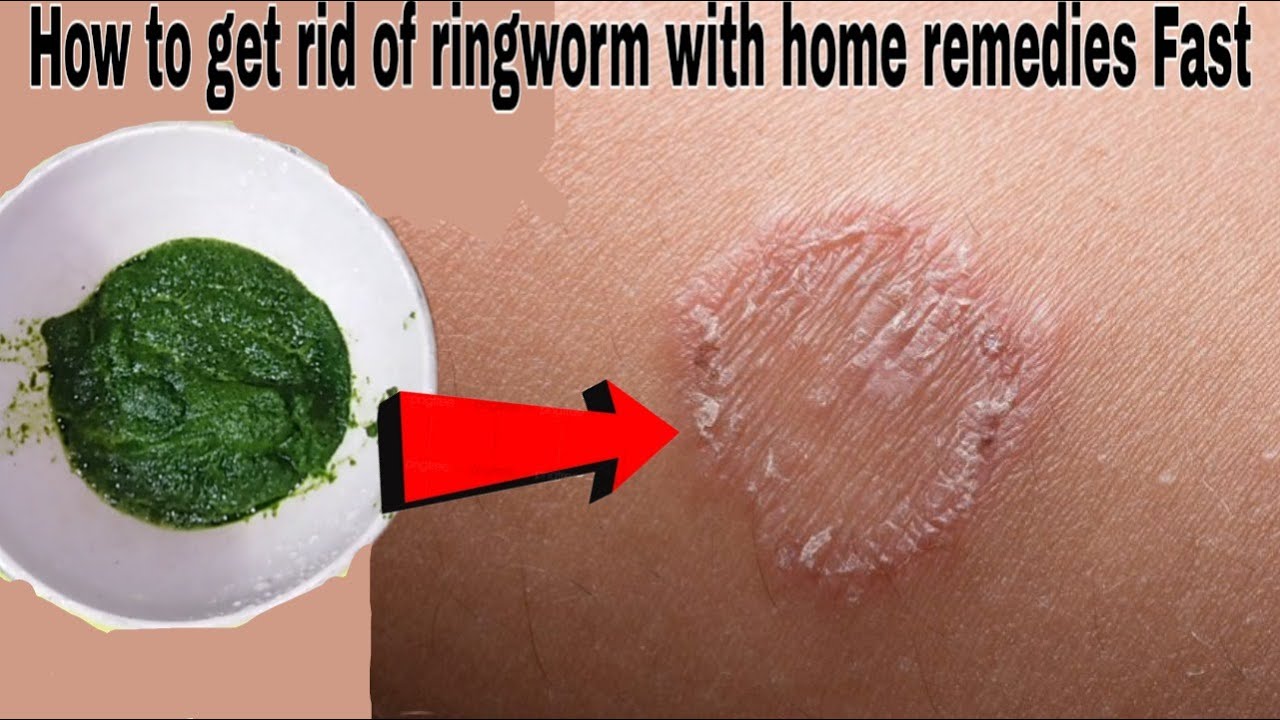 How to Treat Ringworm on a Tattoo at Home - wide 8