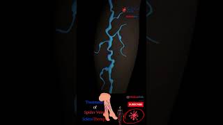 Spider Veins Treatment - Sclerotherapy - Legs Varicose Injection #Shorts
