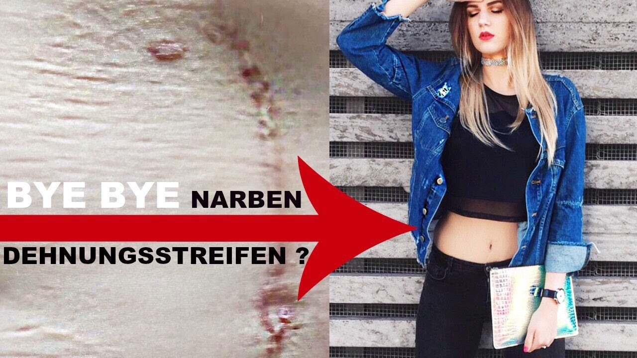 dehnungsstreifen am bauch nach abnehmen