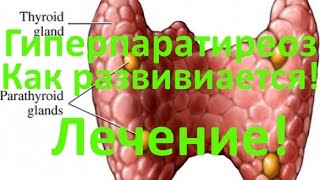 Гиперпаратиреоз - причины, симптомы и лечение Гиперпаратиреоз - причины, симптомы и лечение