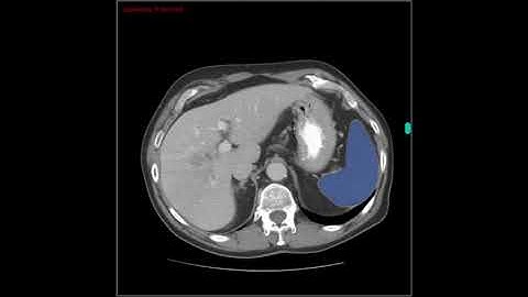 2.5D Spleen segmentation with AI
