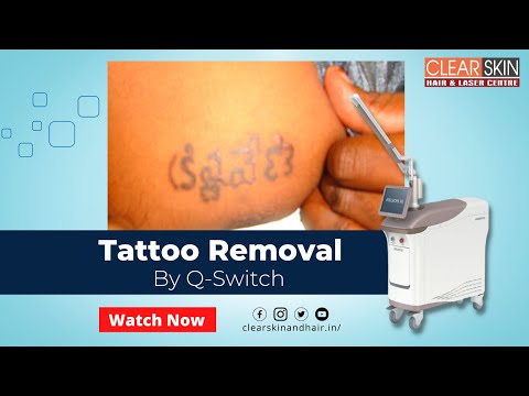 Top Tattoo Removal in Kurnool  Best Permanent Tattoo Removal  Justdial