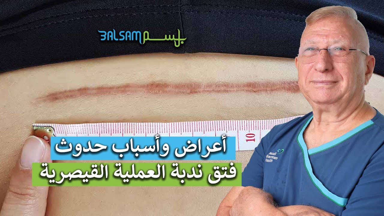 أعراض وأسباب حدوث فتق ندبة العملية القيصرية - البروفيسور موسى الكردي
